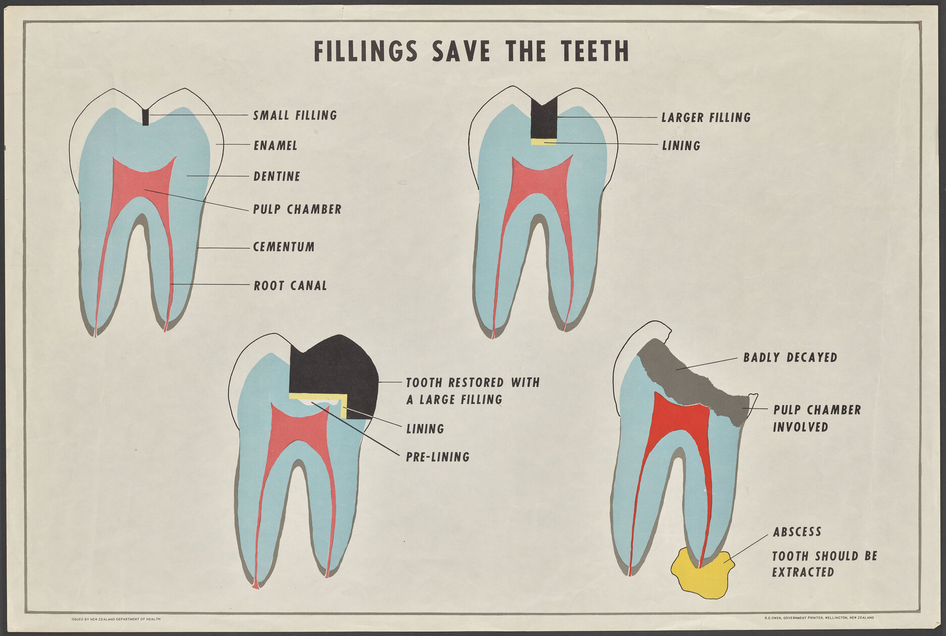 "Fillings Save The Teeth"