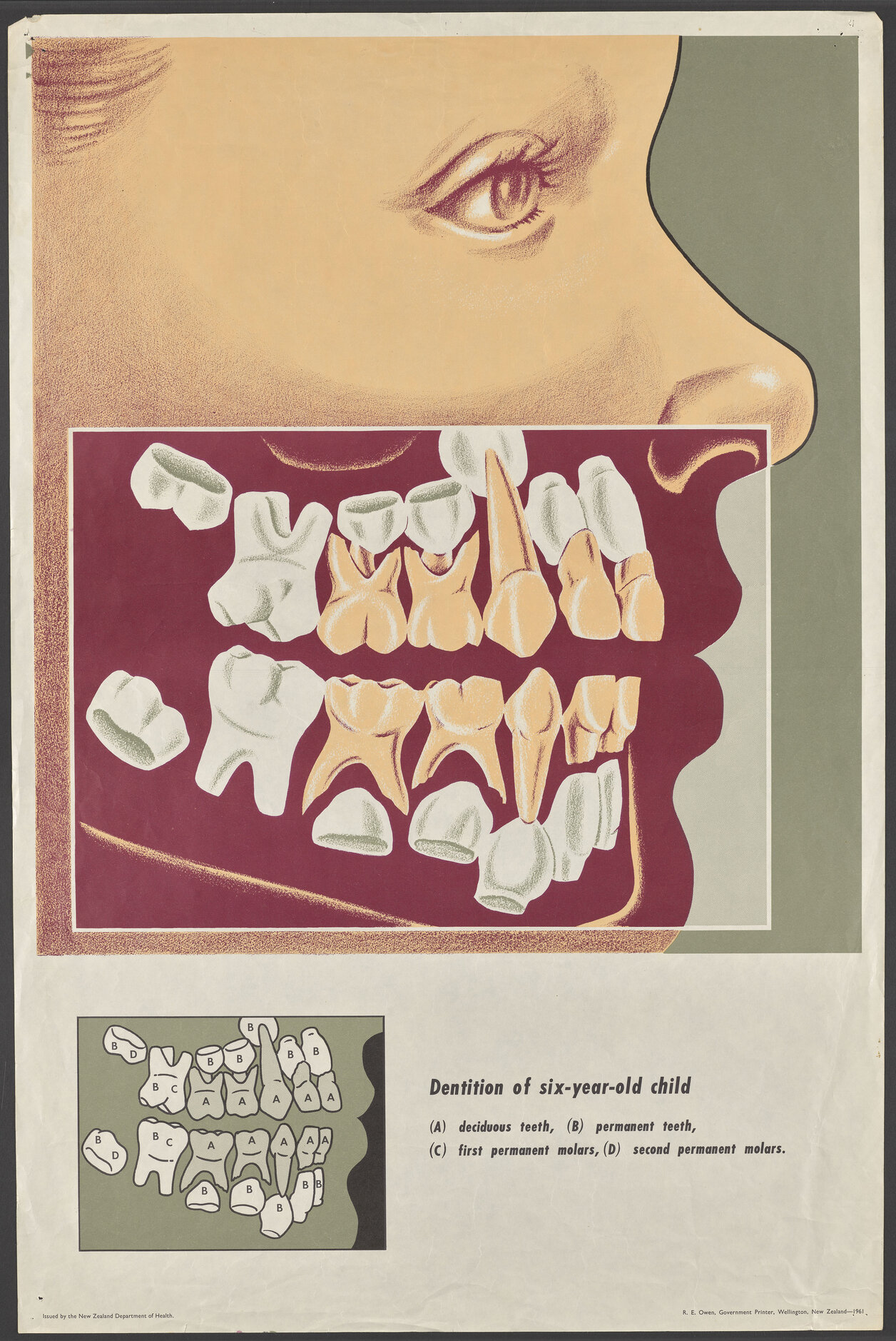 "Dentition of six-year-old child"