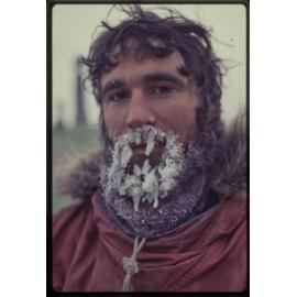 McKerrow shows a white spot of frostbite