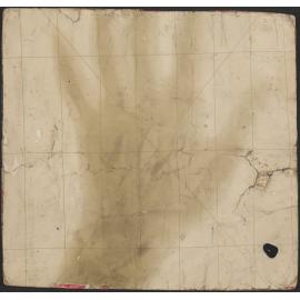 X-ray of Mr R.L. Luke's hand